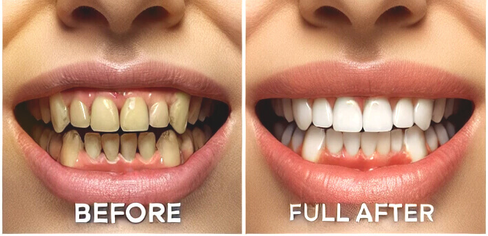 法鉑牙醫聯盟_全口重建