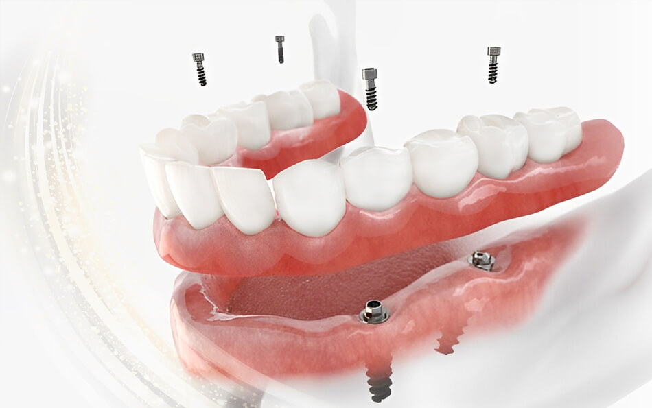 法鉑牙醫聯盟_全口重建