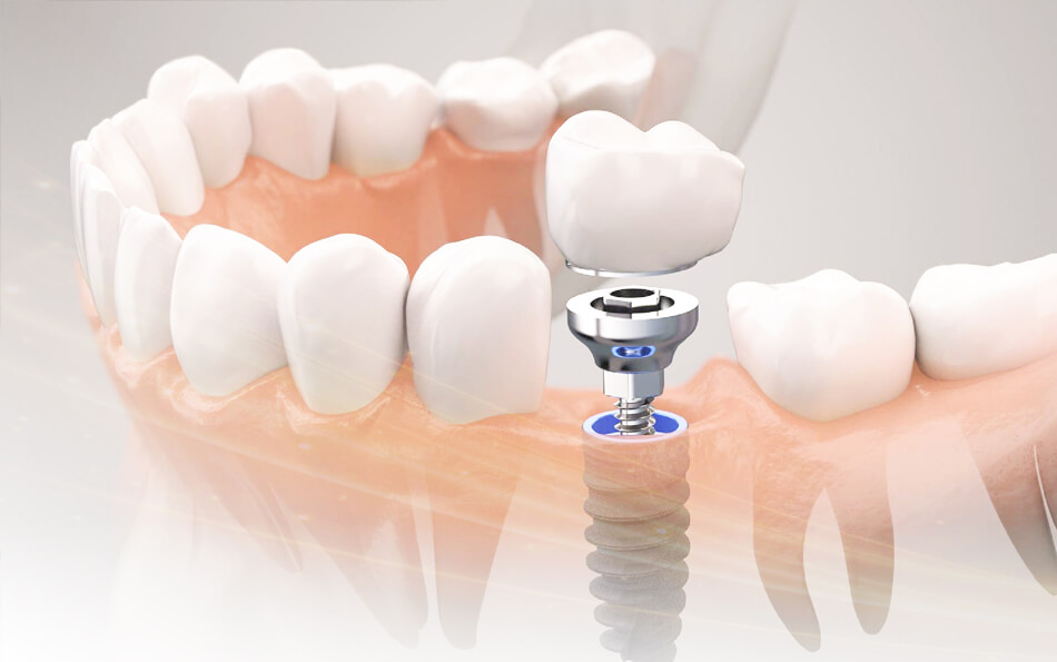 法鉑牙醫聯盟_植牙前必看全攻略