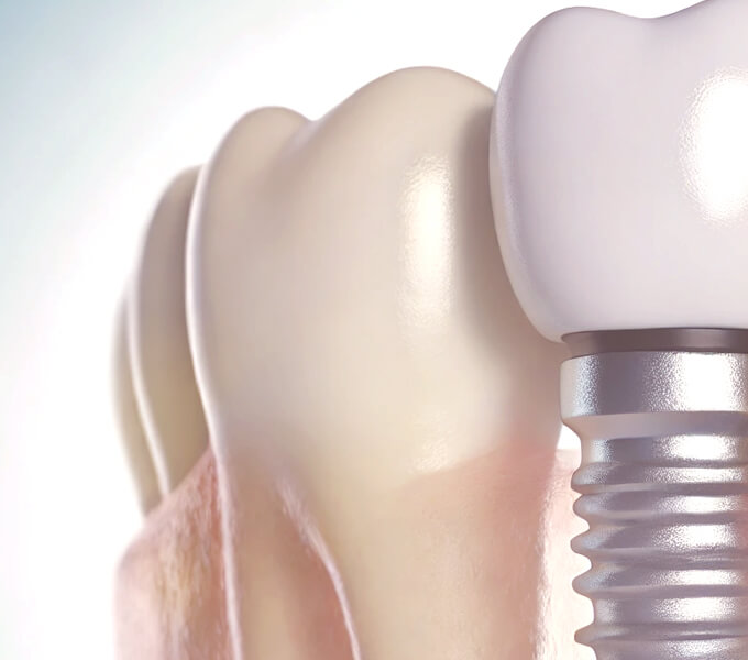 法鉑牙醫聯盟_全口重建