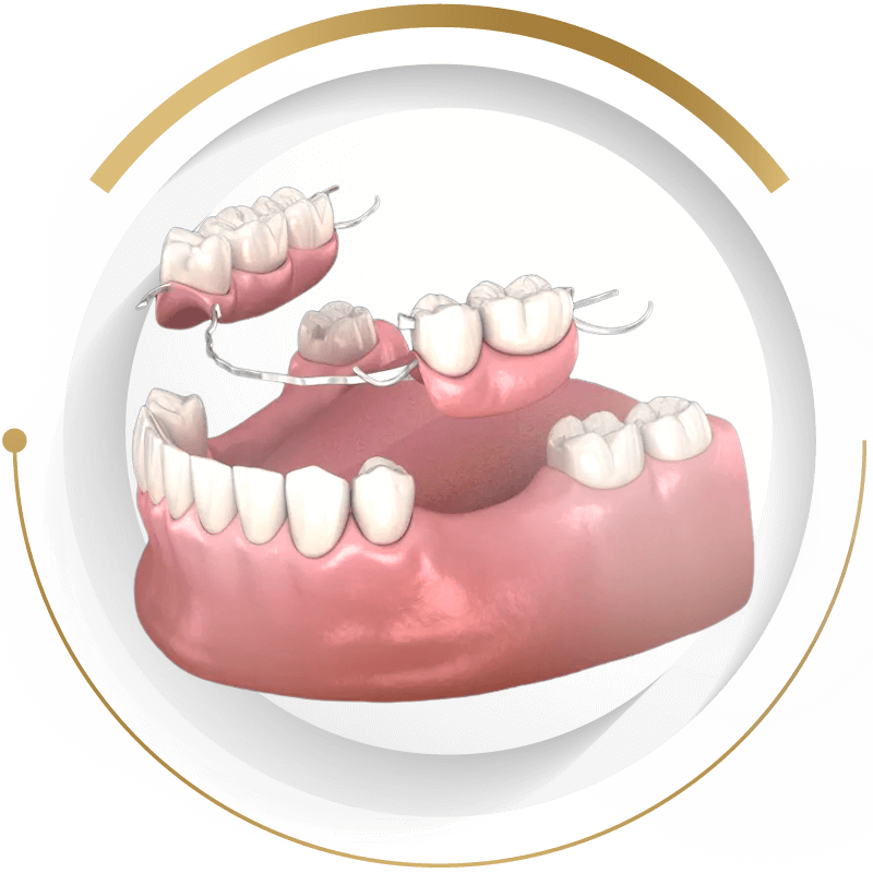 法鉑牙醫診所_活動假牙 (傳統假牙)