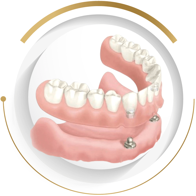 法鉑牙醫診所_半固定鈕扣式活動假牙