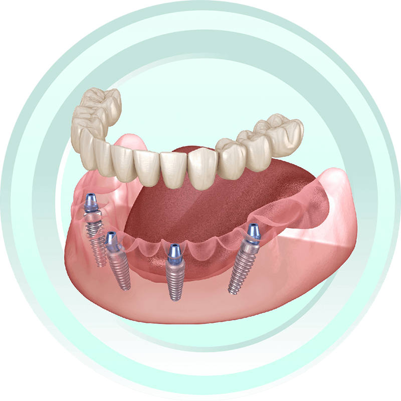 法鉑牙醫診所_全口重建 All-on-4 / All-on-6