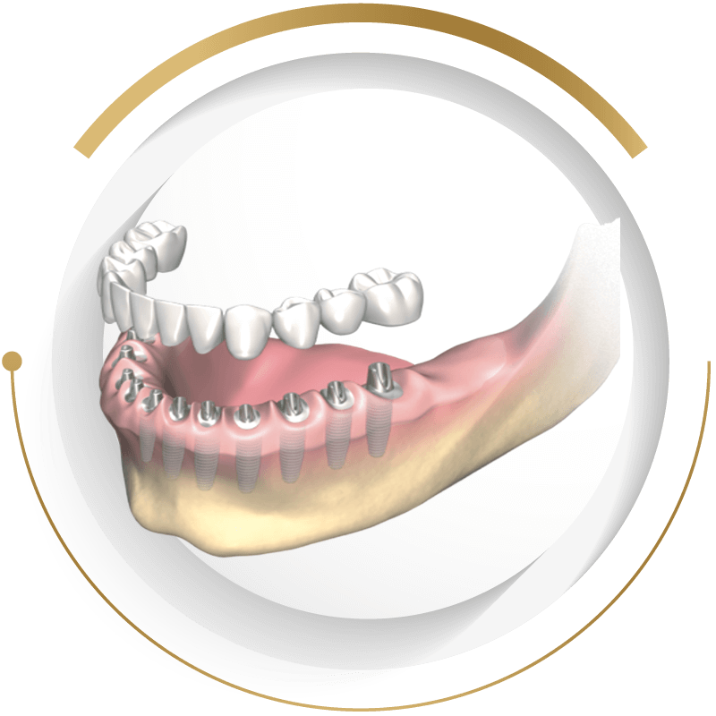 法鉑牙醫診所_全口植牙