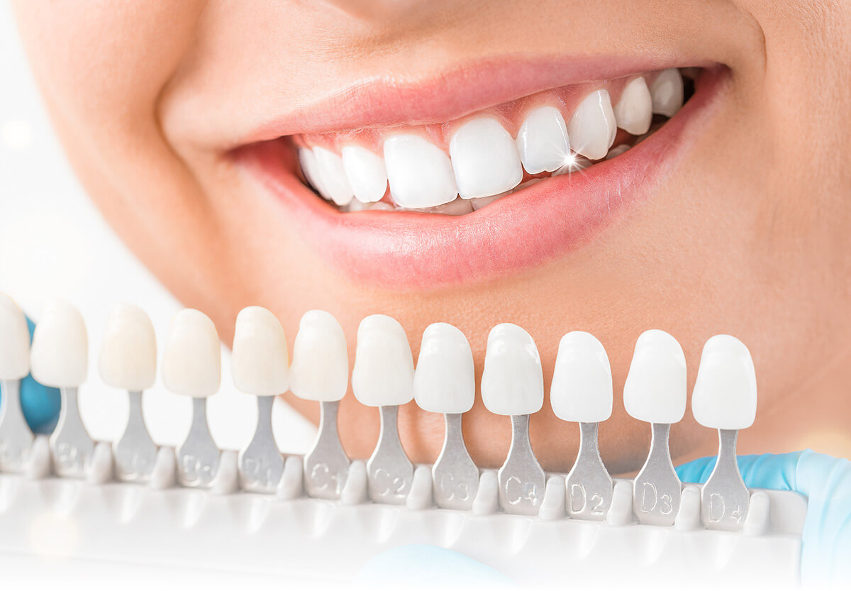 法鉑牙醫診所_全瓷貼片介紹