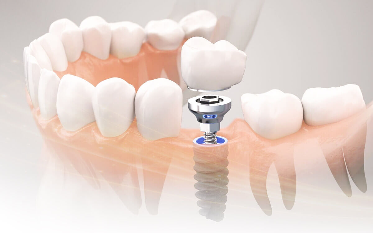 法鉑牙醫聯盟_植牙治療