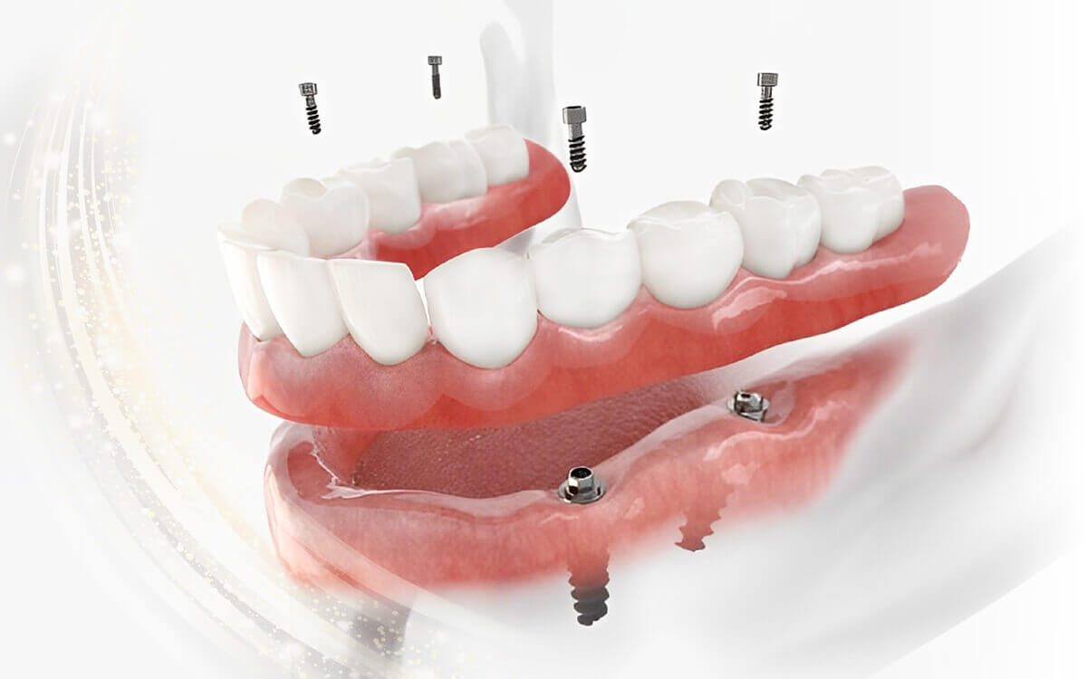 法鉑牙醫聯盟_全口重建