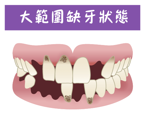 法鉑牙醫聯盟_全口重建_大範圍缺牙