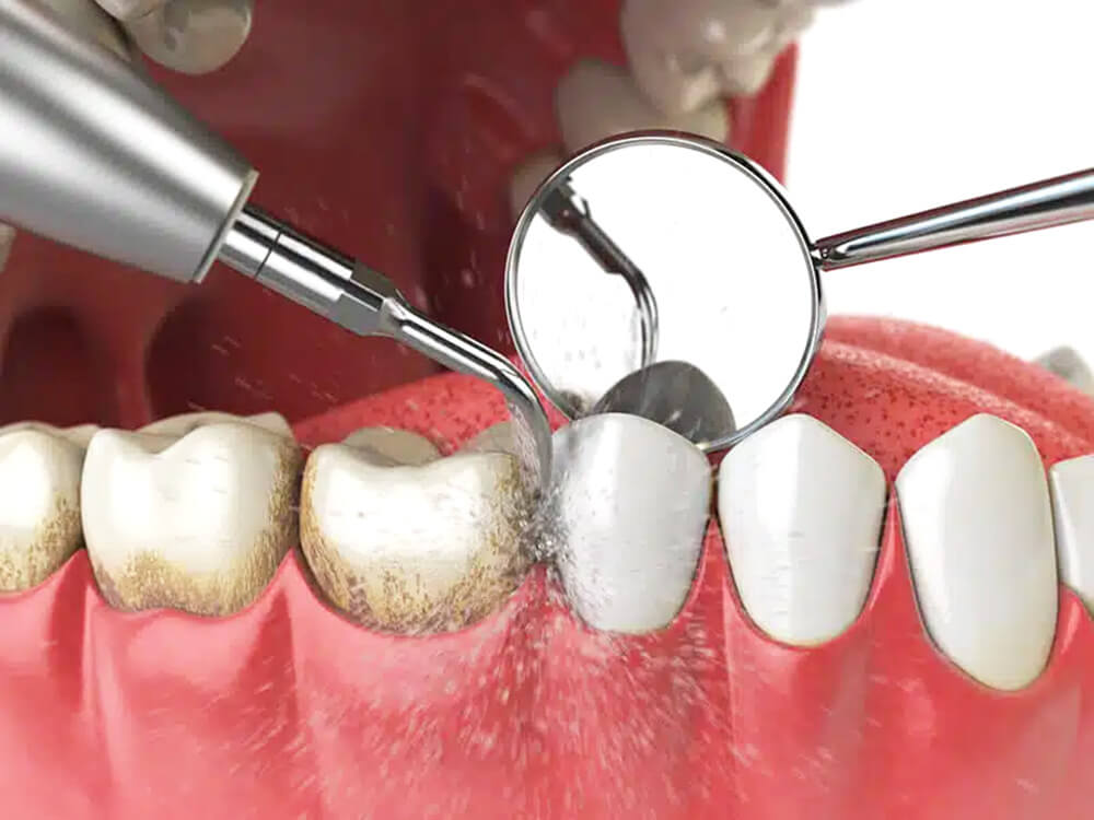 法鉑牙醫診所_洗牙