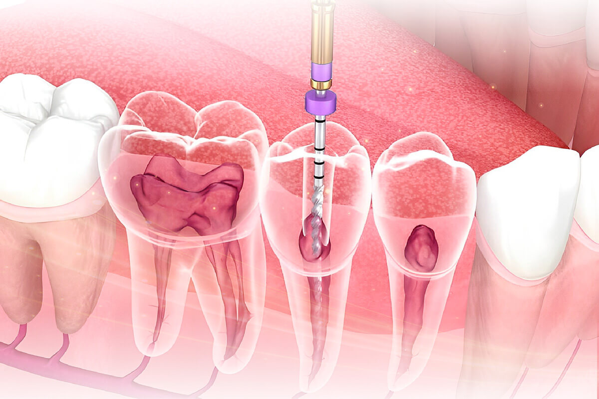 法鉑牙醫診所_根管治療
