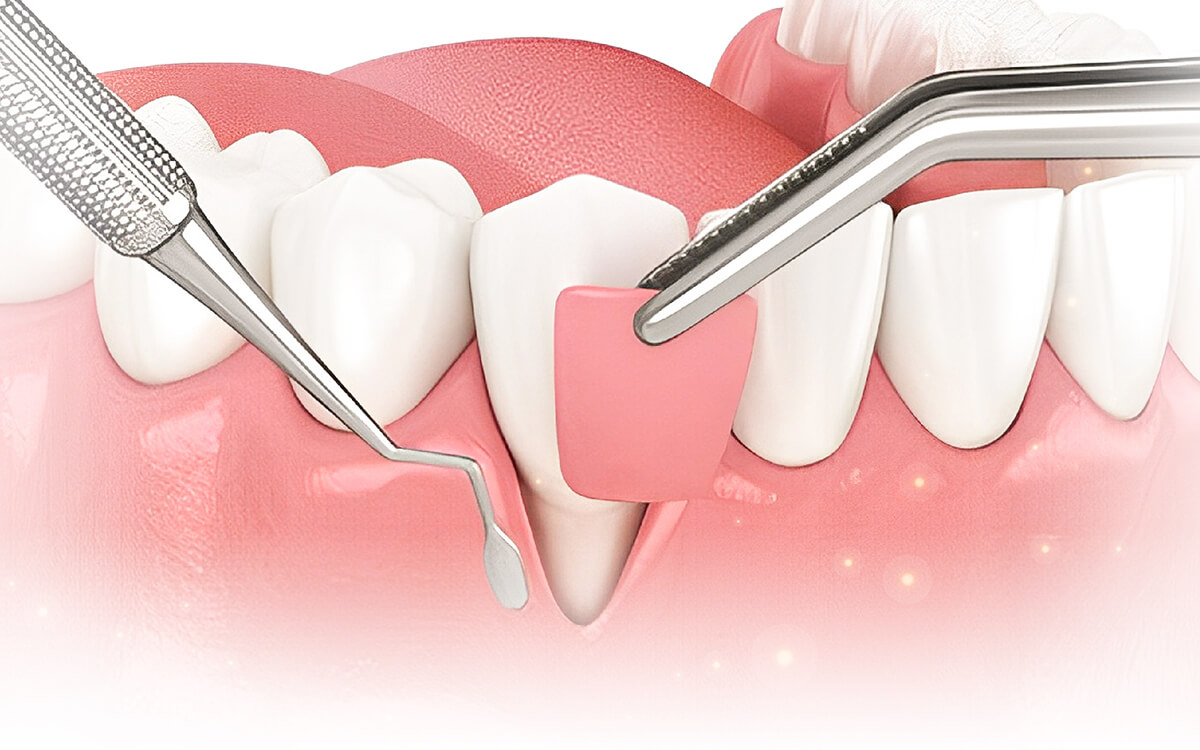 法鉑牙醫聯盟_牙周清創術