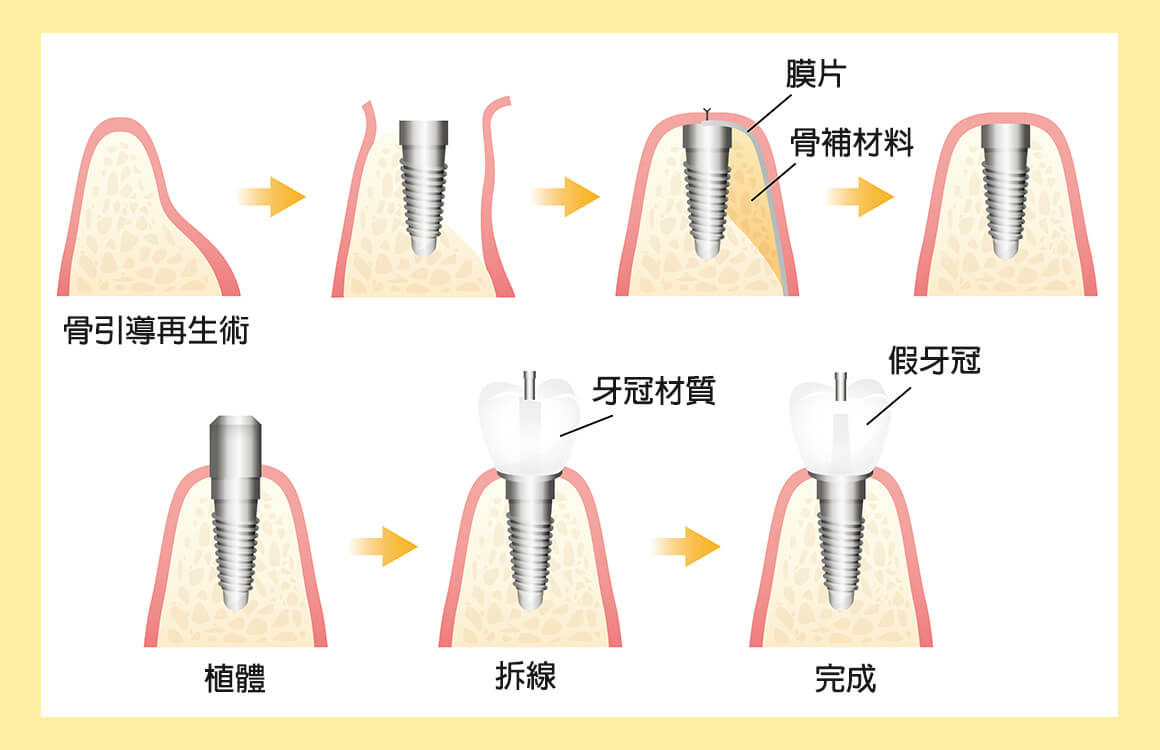 法鉑牙醫診所_骨引導再生術的優勢
