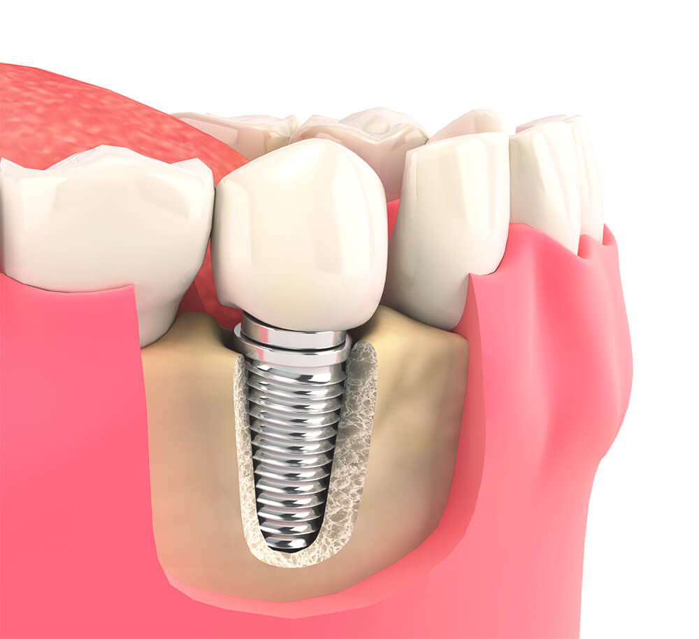法鉑牙醫診所_劈骨擴張術的優勢
